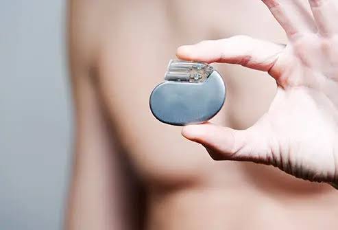 Why Internal Cardiac Defibrillator in UAE Is Transforming Modern Cardiac Care