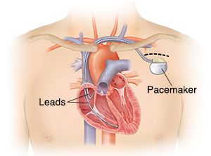 Why Is a Pacemaker Operation in Dubai Essential for Managing Heart Rhythm Disorders?