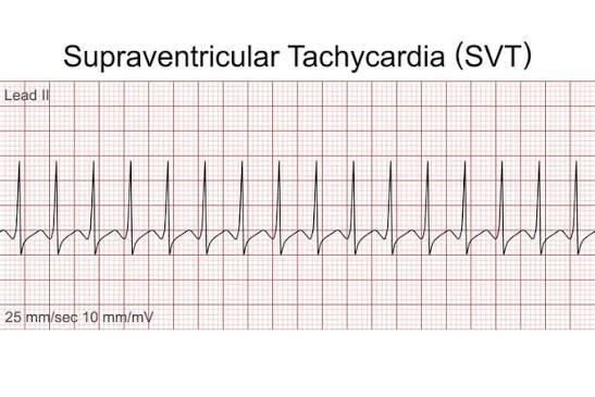 How Can SVT Ablation Help You Regain a Healthy and Normal Heart Rhythm?