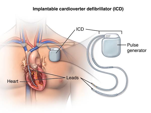 How Can ICD Implant Surgery Help Manage Serious Heart Rhythm Problems?