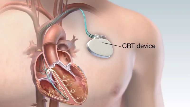 What Should You Know About Pacemakers and Modern Heart Rhythm Care?