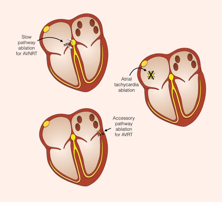 How Can SVT Ablation Help People With Recurring Fast Heartbeats?
